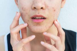 Anti acne cream and gel